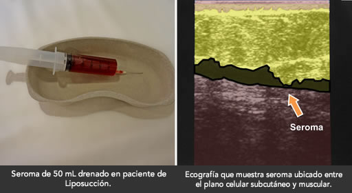 complicaciones-seroma