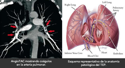 complicaciones-tep