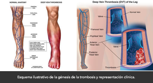 complicaciones-tvp